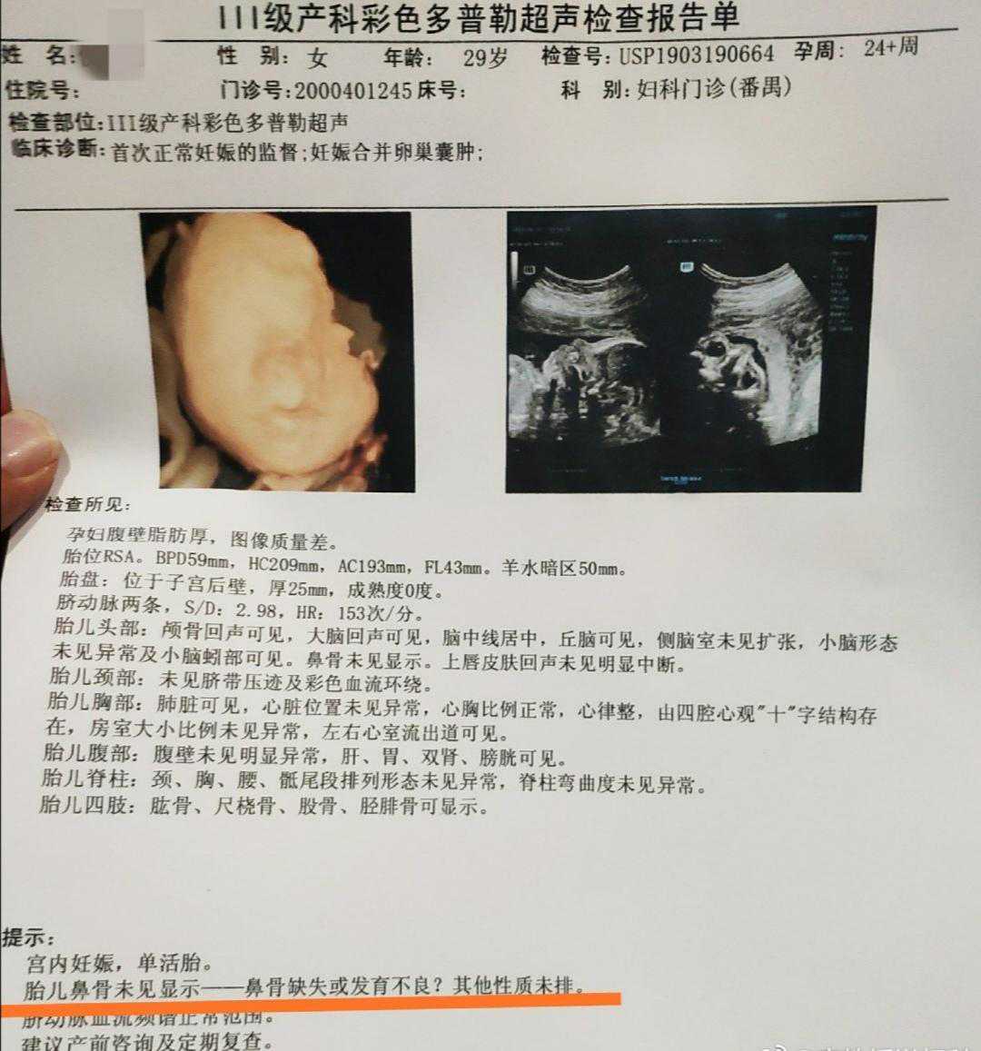 孕期四维大排畸，胎儿鼻骨缺如，还有希望别放弃，给胎儿一个机会