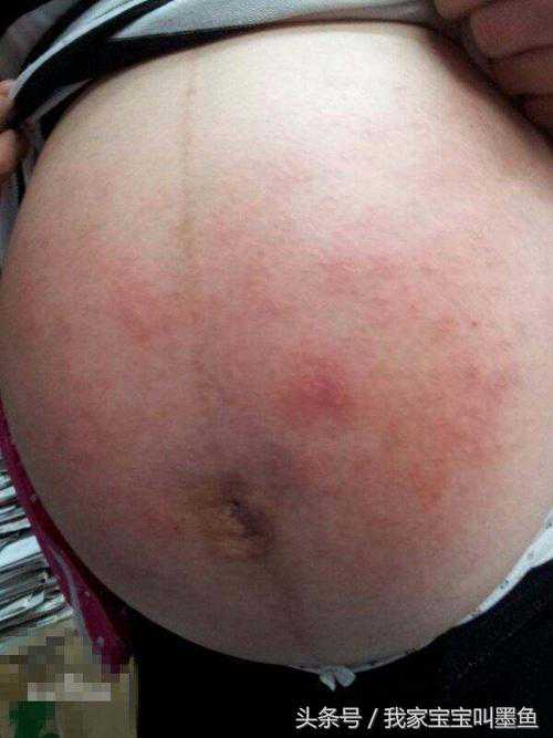 孕期皮肤瘙痒也会导致胎停育？当心是它在捣鬼
