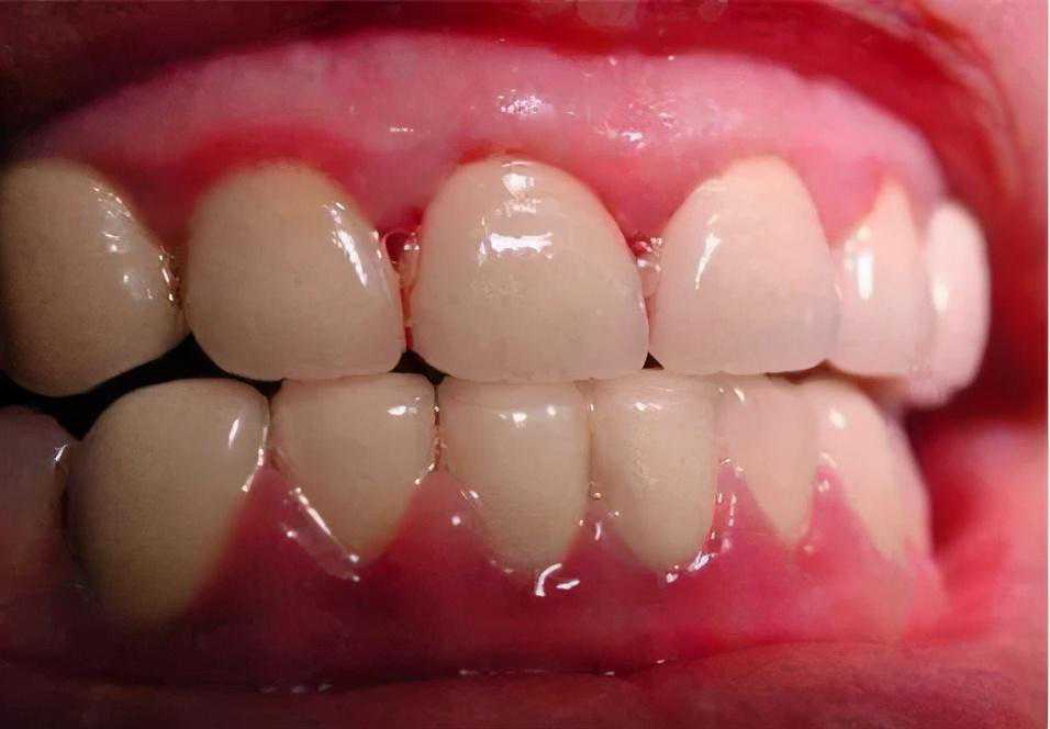 备孕期不得不做的N件事之检查牙齿